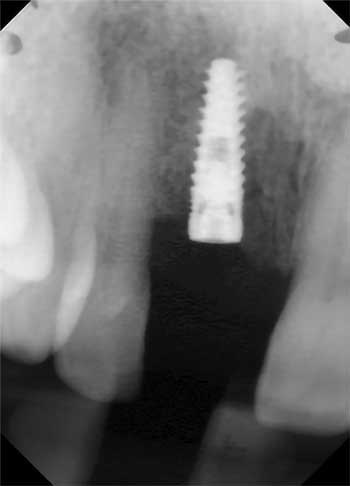 permanent first molar extraction