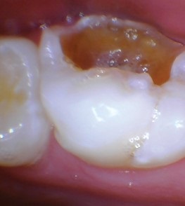 permanent first molar extraction