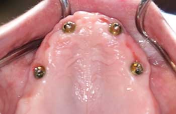 Implant Guided Prosthesis