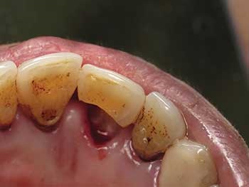 Show Your Work: Restoring Deep Root Caries