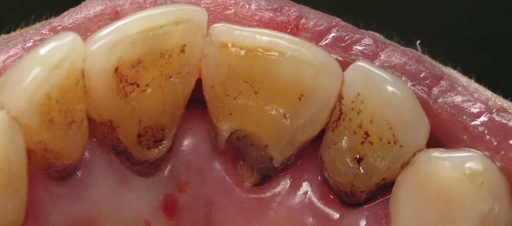 Show Your Work: Restoring Deep Root Caries